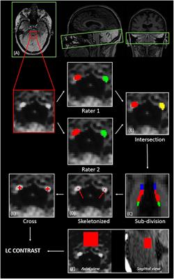 Locus coeruleus features are linked to vagus nerve stimulation response in drug-resistant epilepsy